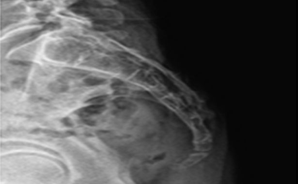 수술후 유착 MRI 소견